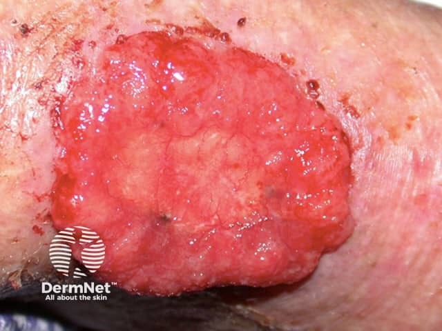 Basal cell carcinoma affecting the face