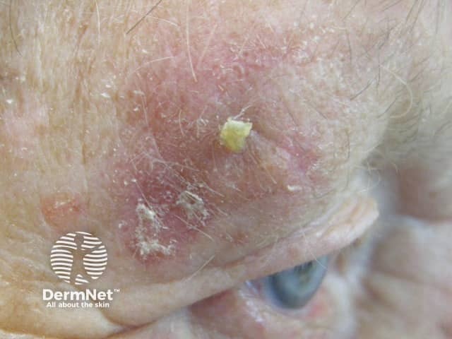 Actinic Keratoses affecting the face