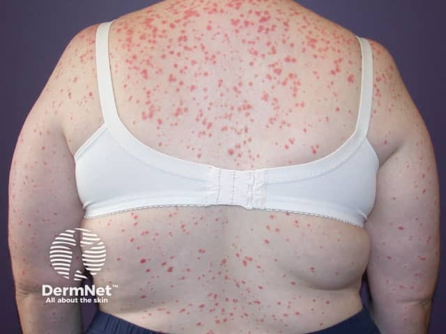 Guttate psoriasis