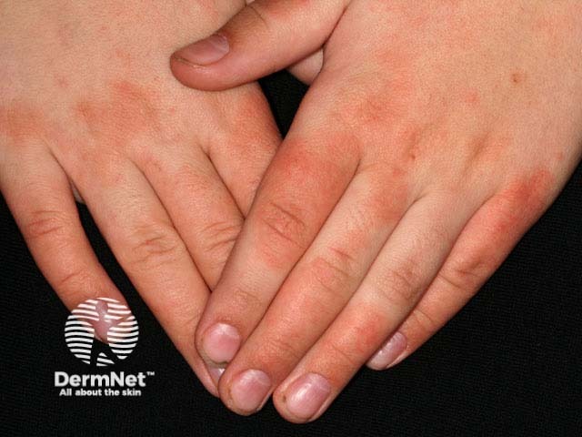 Hand dermatitis on the dorsal fingers in an atopic boy