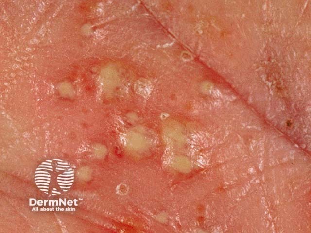 Pustules on the palm due to PPP