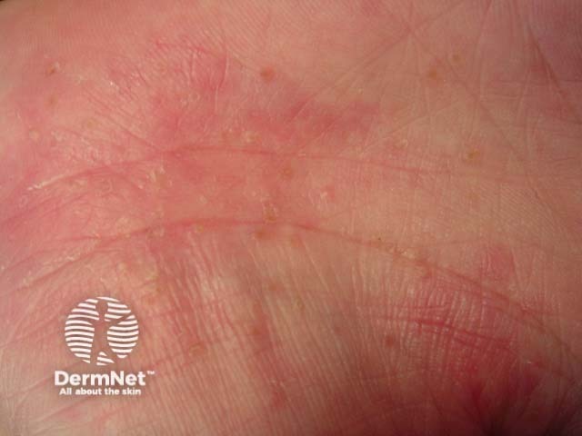 Pustular psoriasis of the hands and feet