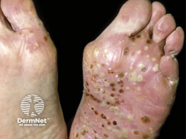 Florid pustules on the feet due to PPP