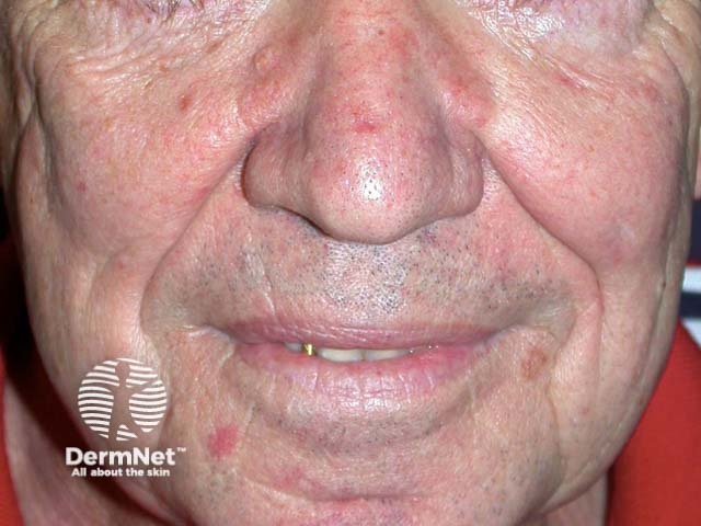 Sebaceous hyperplasia