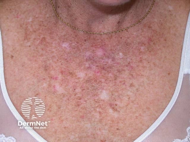 Actinic Keratoses affecting the face