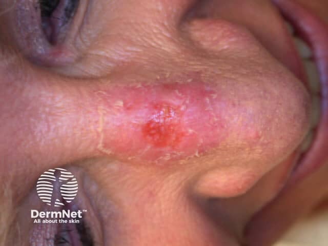 One week after MAL PDT