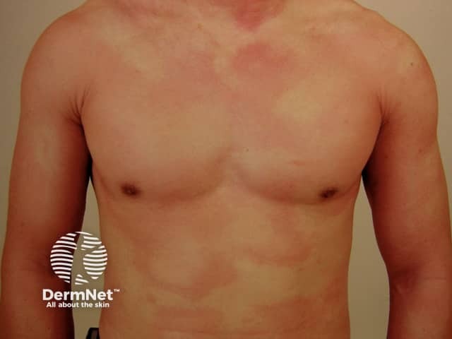 Acute urticaria