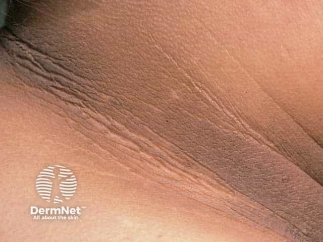 Velvet-like neck acathosis nigricans