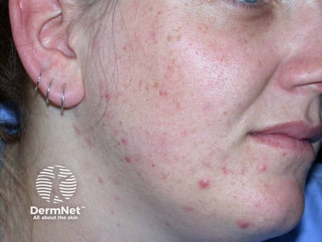 Facial acne