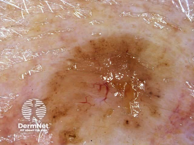 Pigmented basal cell carcinoma dermoscopy