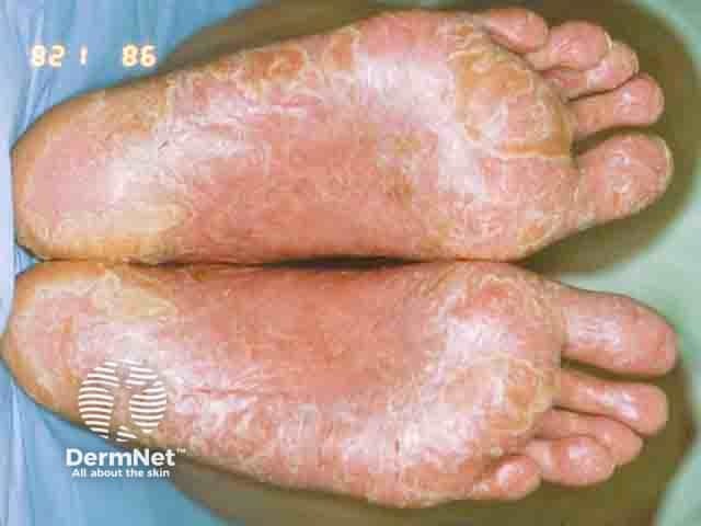 Allergic contact dermatitis of the sole - rubber, leather and PTBP resin are all possible culprits