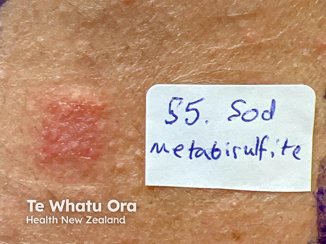 A positive patch test reaction to sodium metabisulphite (metabisulfite)