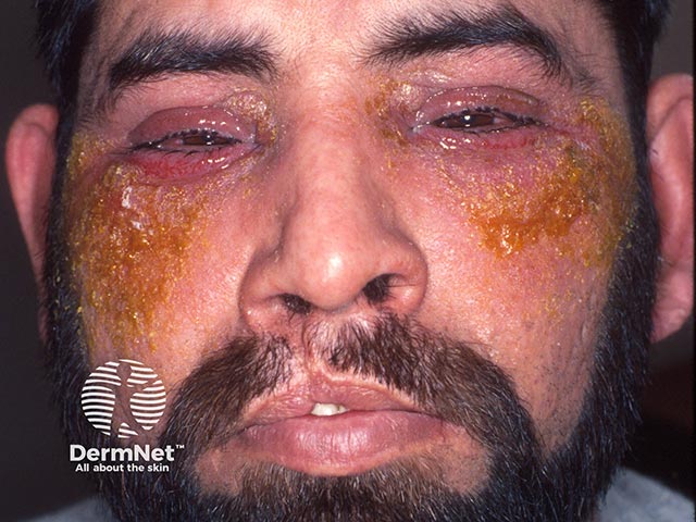 Allergic contact dermatitis due to neomycin in an eye drop