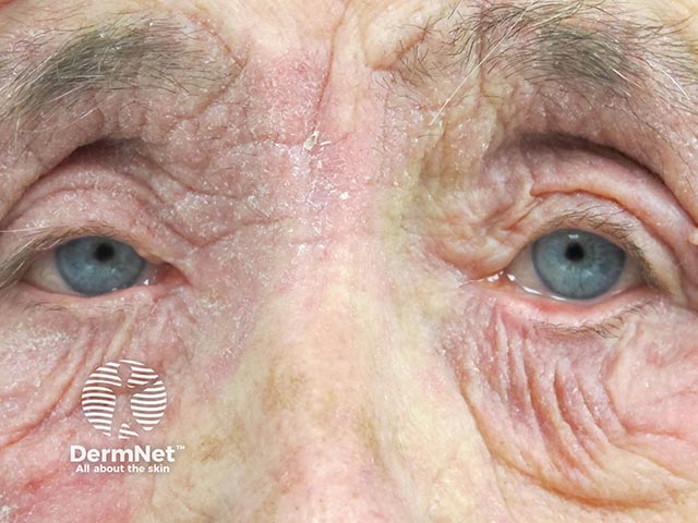 Allergic blepharitis due to benzalkonium chloride in an eye drop