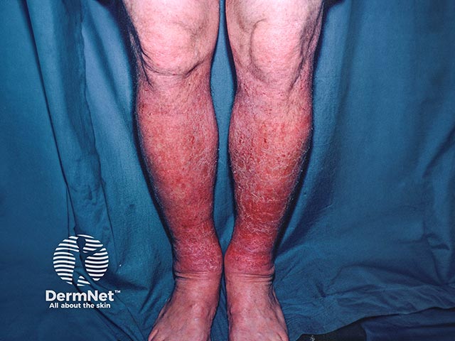 Allergic contact dermatitis on the legs - bandage constituents and medicaments are common causes
