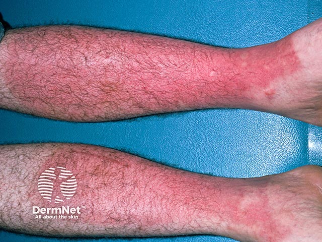 Allergic contact dermatitis on the legs - bandage constituents and medicaments are common causes. This case was due to rubber in a pair of boots