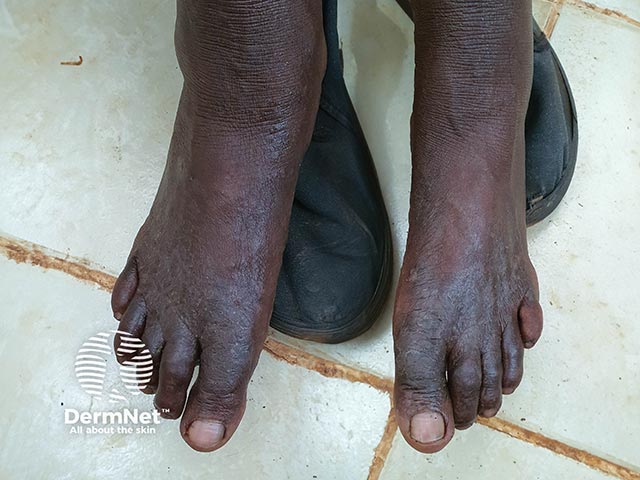 Chronic rubber dermatitis on the feet 