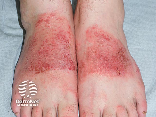 Allergic shoe dermatitis