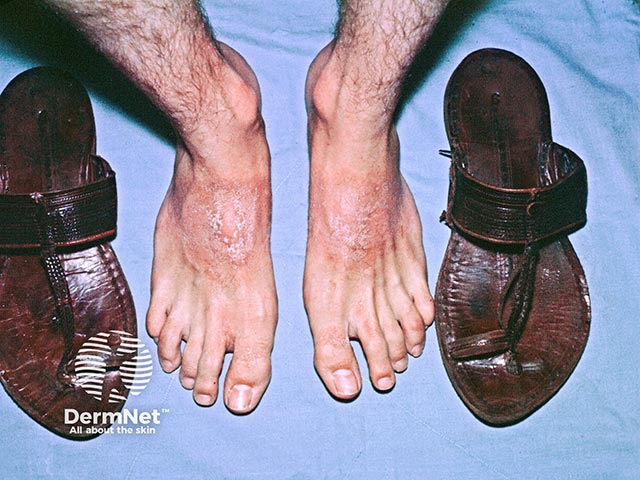 Contact dermatitis on the feet - chromate in the sandals was the offending allergen