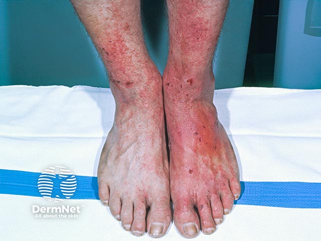 Allergic contact dermatitis due to a shoe constituent