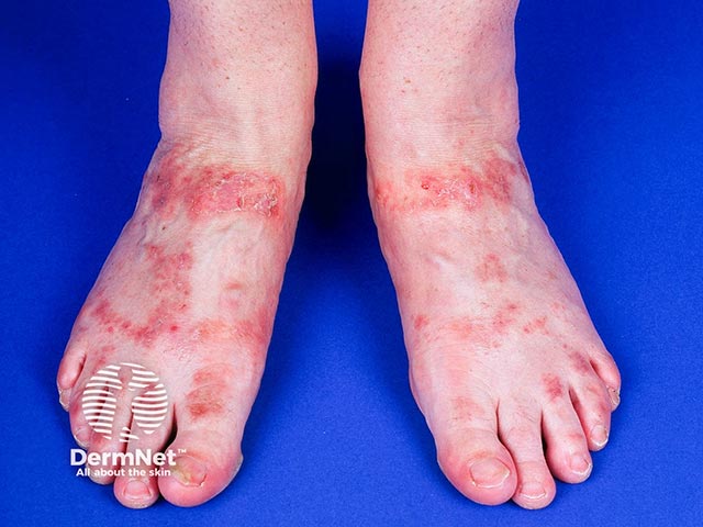 Chromate allergic contact dermatitis due to a leather sandal