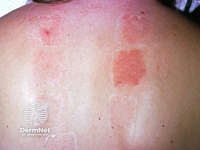 A positive patch test to acrylate