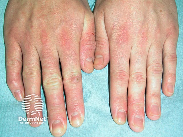 Allergic contact dermatitis in a floorer due to epoxy resin sealant use