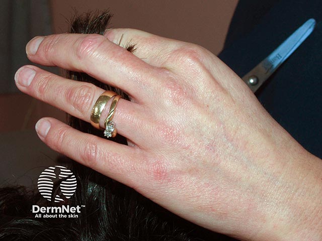 An occupational contact dermatitis on the fingers in a hairdresser - it is worse on the index and middle finger from holding the hair to cut it