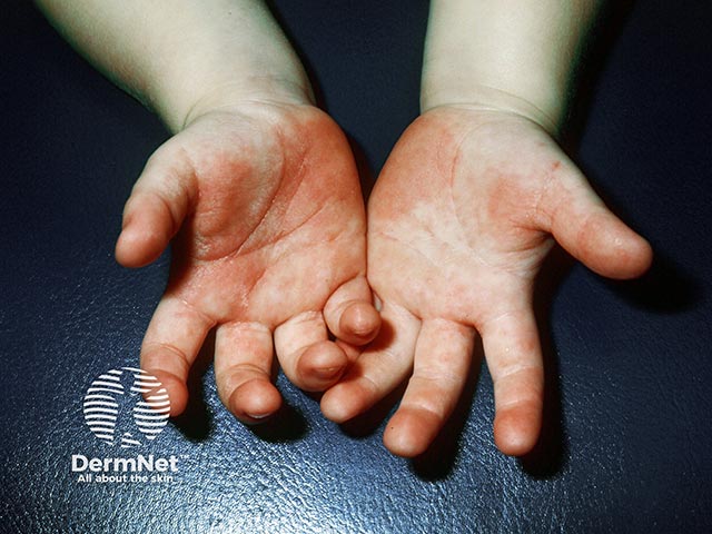 Allergic contact dermatitis in a 2-year-old from exposure to cement, often due to chromium