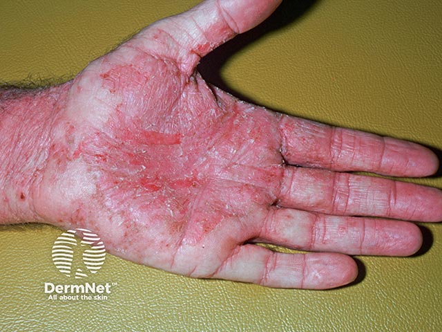 Allergic contact dermatitis in a builder due to chromate in cement