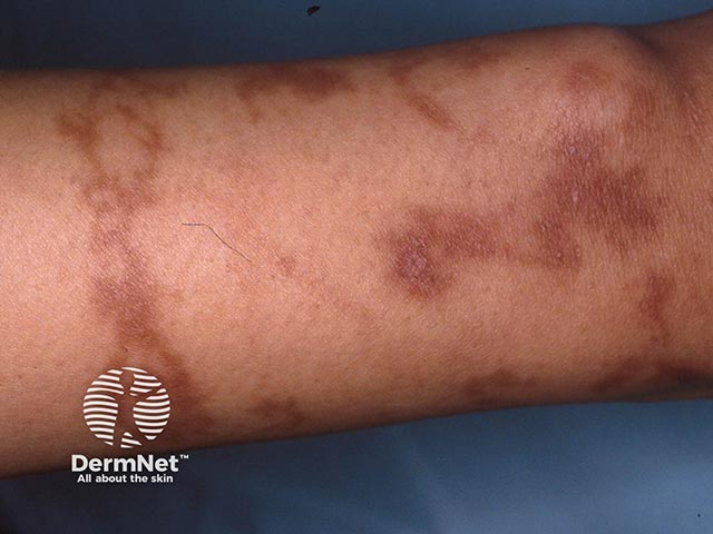 Post-inflammatory pigmentation after reacting to paraphenylenediamine (PPD) in a temporary 'henna' tattoo