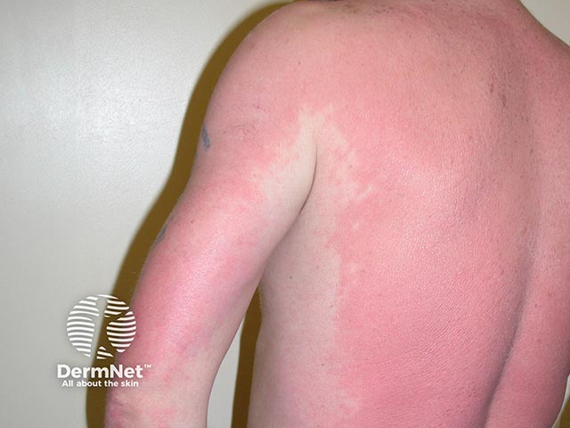 Acute contact allergy to dimethyl fumarate - the 'Chinese sofa dermatitis' allergen