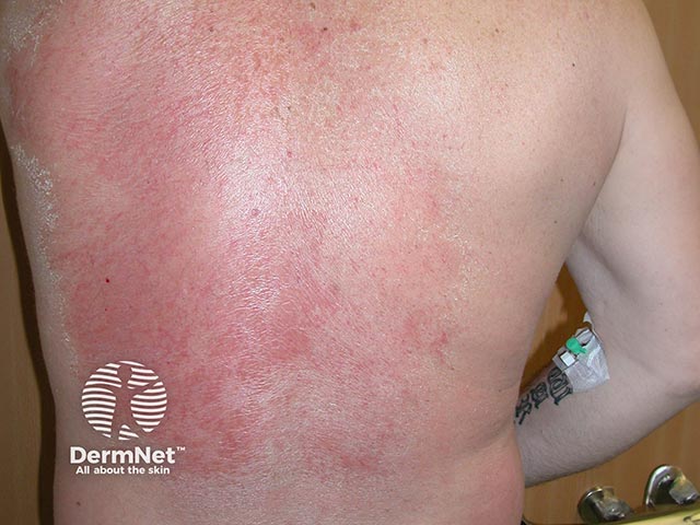Acute contact allergy to dimethyl fumarate - the 'Chinese sofa dermatitis' allergen