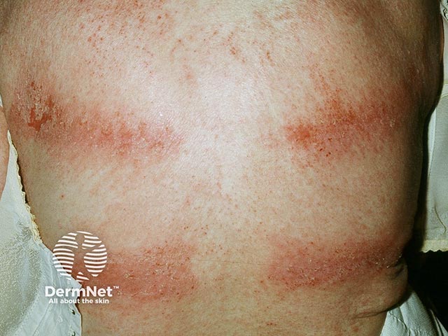 Contact dermatitis due to elastic in the bra straps