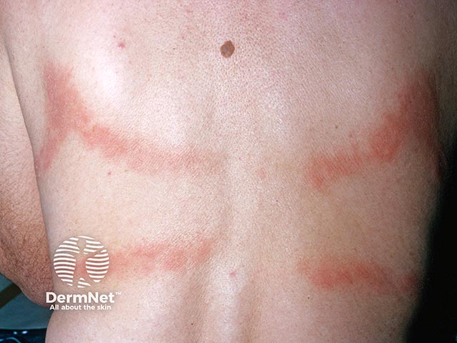 Contact allergy to elastane in a bra