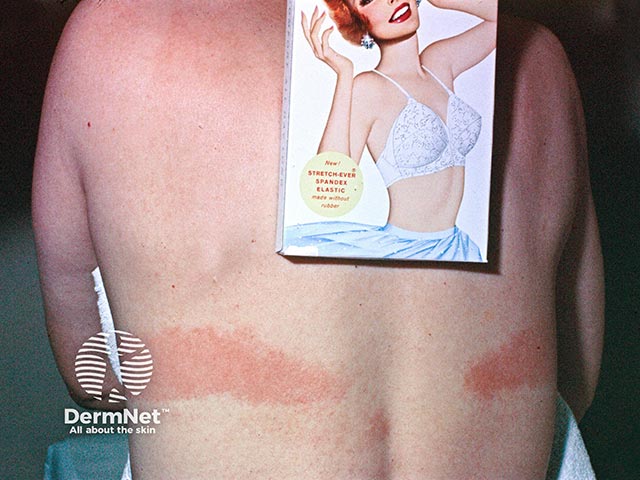 Contact allergy to a bra constituent