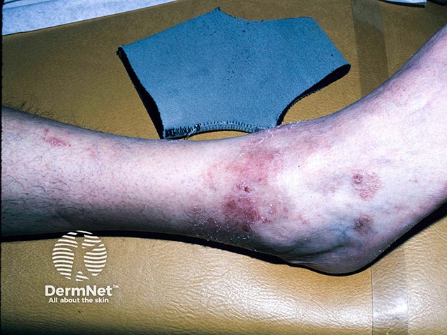 Contact allergy to a neoprene ankle brace