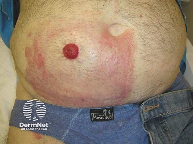 Allergy to a stoma bag constituent