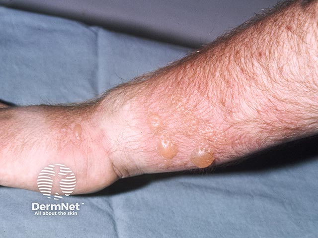Bullous allergic contact dermatitis - there is sparing below the watch band 