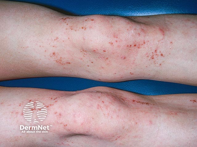 Allergy to epoxy resin in knee patches in 'toughskin' jeans