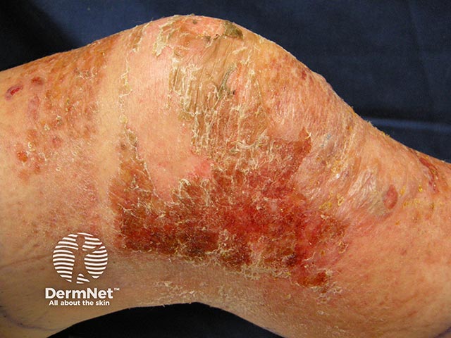 Contact allergy due to colophony in an adhesive tape