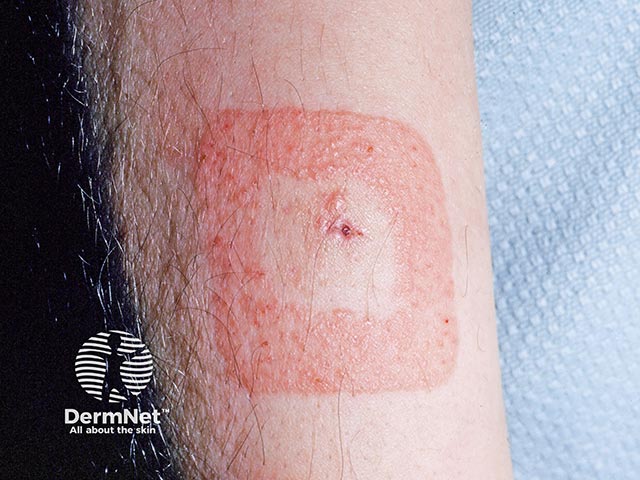 Allergic contact dermatitis due to an acrylate in a dressing adhesive - there is sparing beneath the absorbent pad in the middle of the dressing