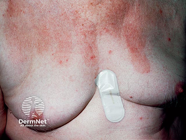 Contact allergy to a glyceryl trinitrate (GTN) patch