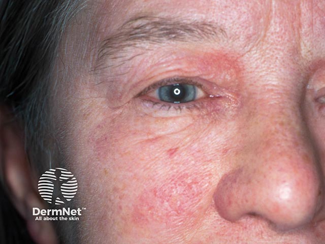 Contact allergy to nickel in a spectacle frame