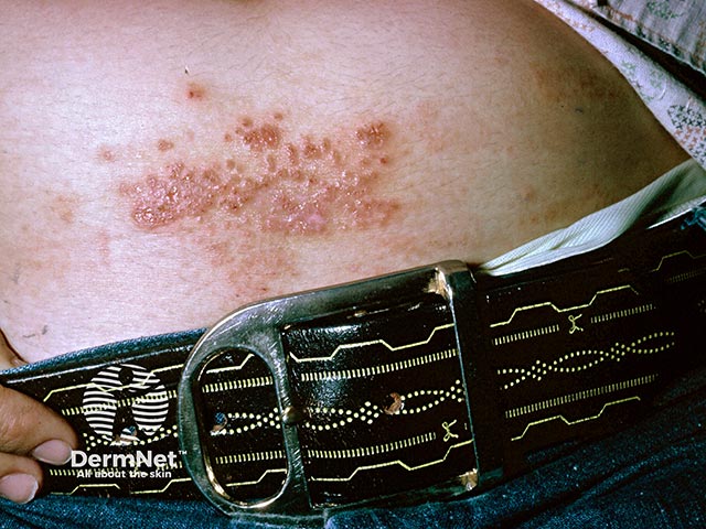 Nickel allergy due to a belt buckle on the lower abdomen