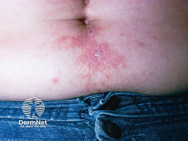 Nickel allergy on the lower abdomen due to a jeans snap