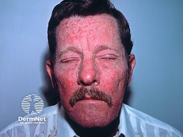 An airborne contact allergy on the face to ragweed pollen