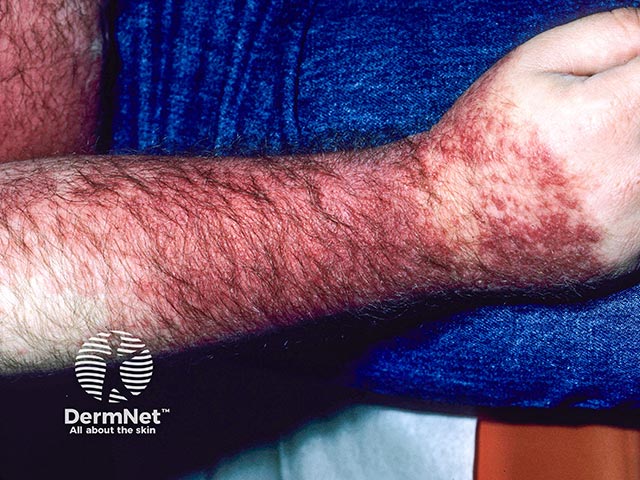 Allergic contact dermatitis on the arms due to rosewood dust