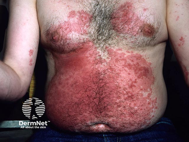 Rosewood dust allergy causing chest and abdominal dermatitis