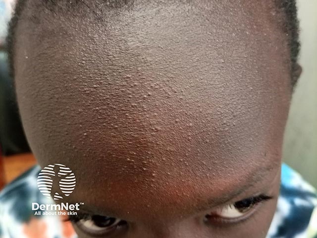 Contact dermatitis on the face due to a herbal face soap